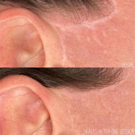dallas best tattoo studio for scars|Scar Camouflage Tattooing .